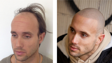 Tony before and after procedure