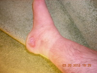 Forests foot injury.JPG