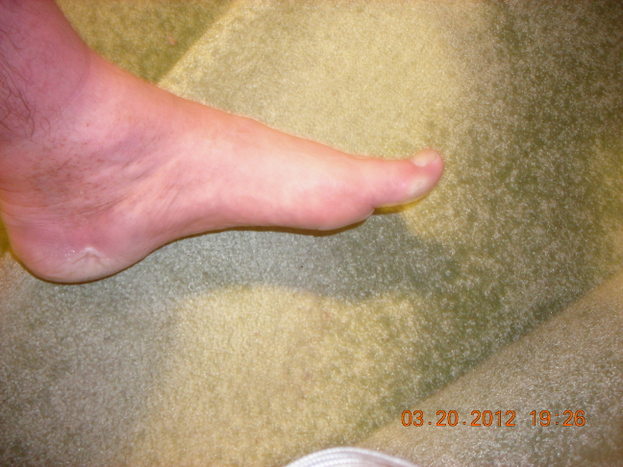 Forests other foot injury.JPG